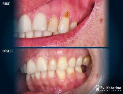 PREKRIVANJE GINGIVALNIH RECESIJA