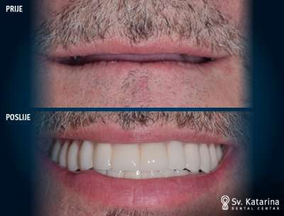 ALL-ON-4 DENTALNI IMPLANTATI