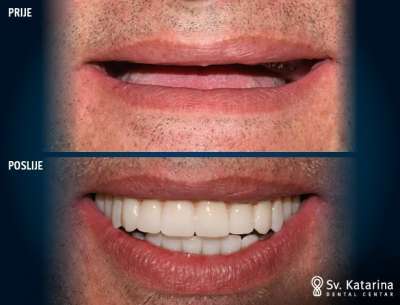 ALL-ON-6 DENTALNI IMPLANTATI